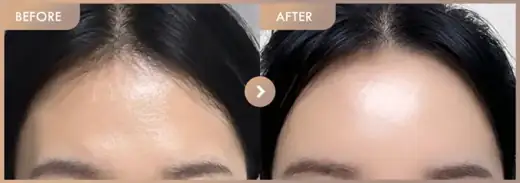 Forehead fillers: before-and-after comparison at Newstar Clinic