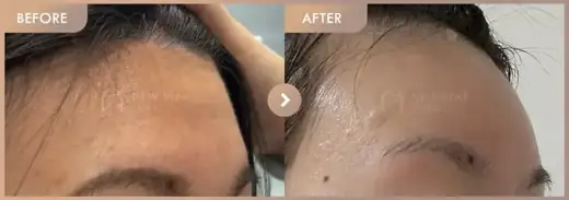 Forehead fillers: before-and-after comparison at Newstar Clinic