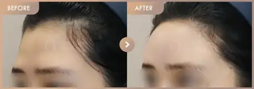 Forehead fillers: before-and-after comparison at Newstar Clinic