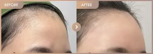 Forehead fillers: before-and-after comparison at Newstar Clinic