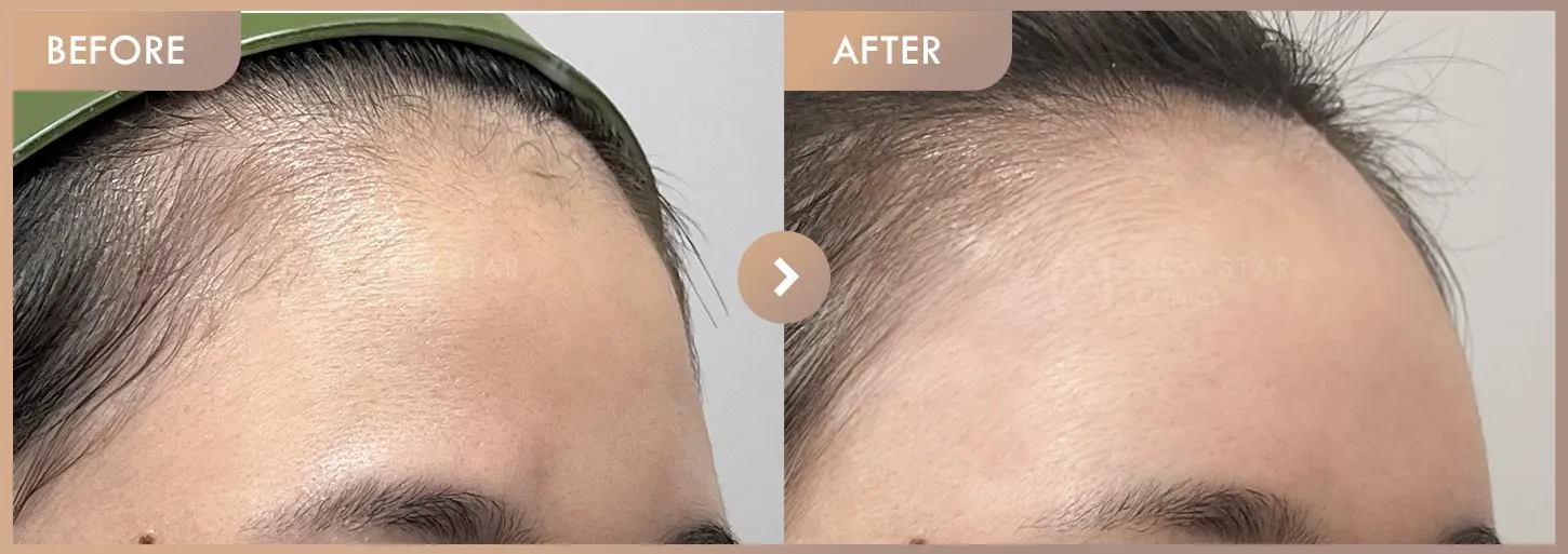 Forehead fillers before-and-after photos at Newstar Clinic