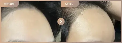 Forehead fillers: before-and-after comparison at Newstar Clinic