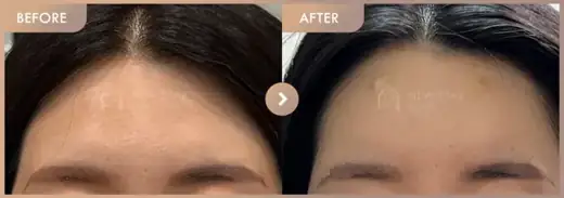 Forehead fillers: before-and-after comparison at Newstar Clinic