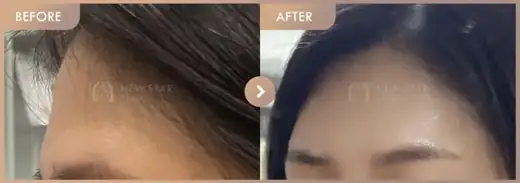 Forehead fillers: before-and-after comparison at Newstar Clinic