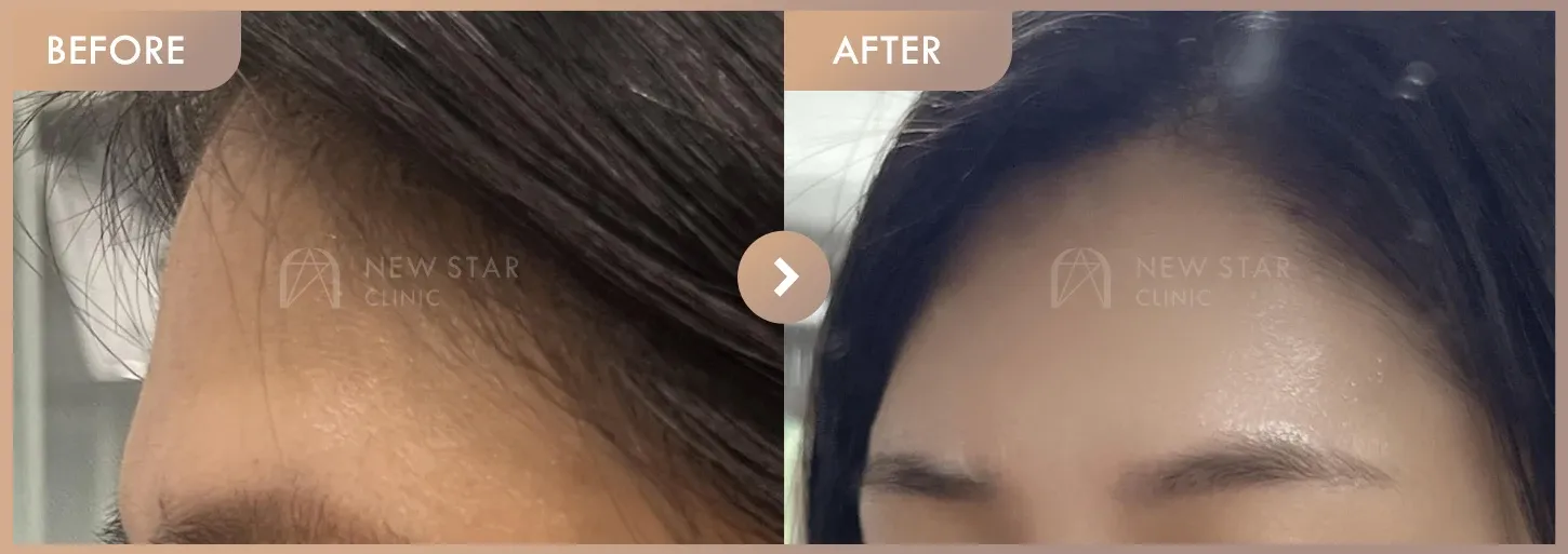 Forehead fillers before-and-after photos at Newstar Clinic