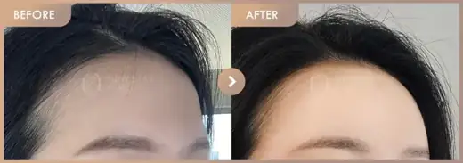 Forehead fillers: before-and-after comparison at Newstar Clinic