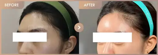 Forehead fillers: before-and-after comparison at Newstar Clinic