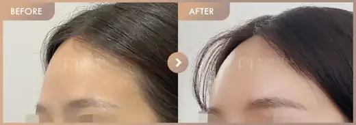 Forehead fillers: before-and-after comparison at Newstar Clinic