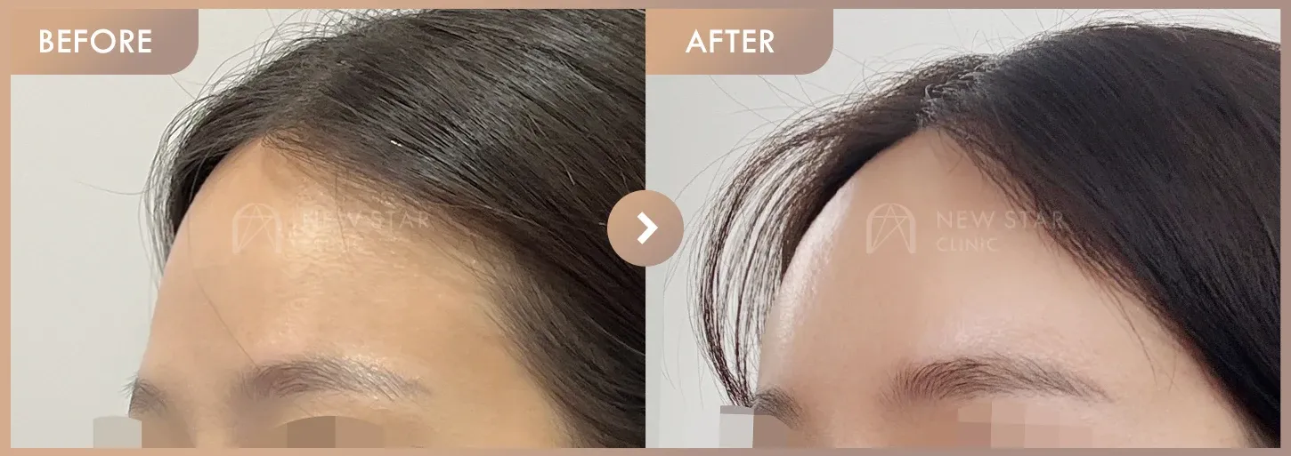 Forehead fillers before-and-after photos at Newstar Clinic