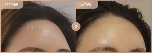 b-0758-41e4-836e-76bb49946abd: before-and-after comparison at Newstar Clinic