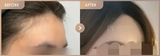 Forehead fillers: before-and-after comparison at Newstar Clinic