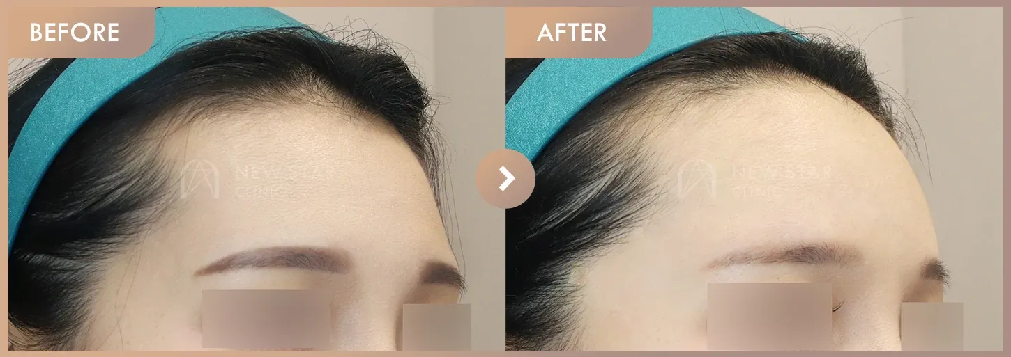 Forehead fillers before-and-after photos at Newstar Clinic
