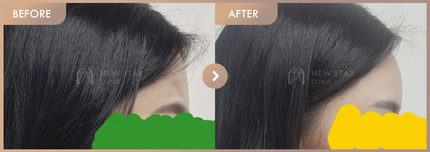 Forehead fillers before-and-after photos at Newstar Clinic