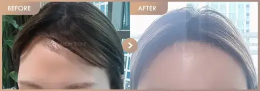 Forehead fillers: before-and-after comparison at Newstar Clinic