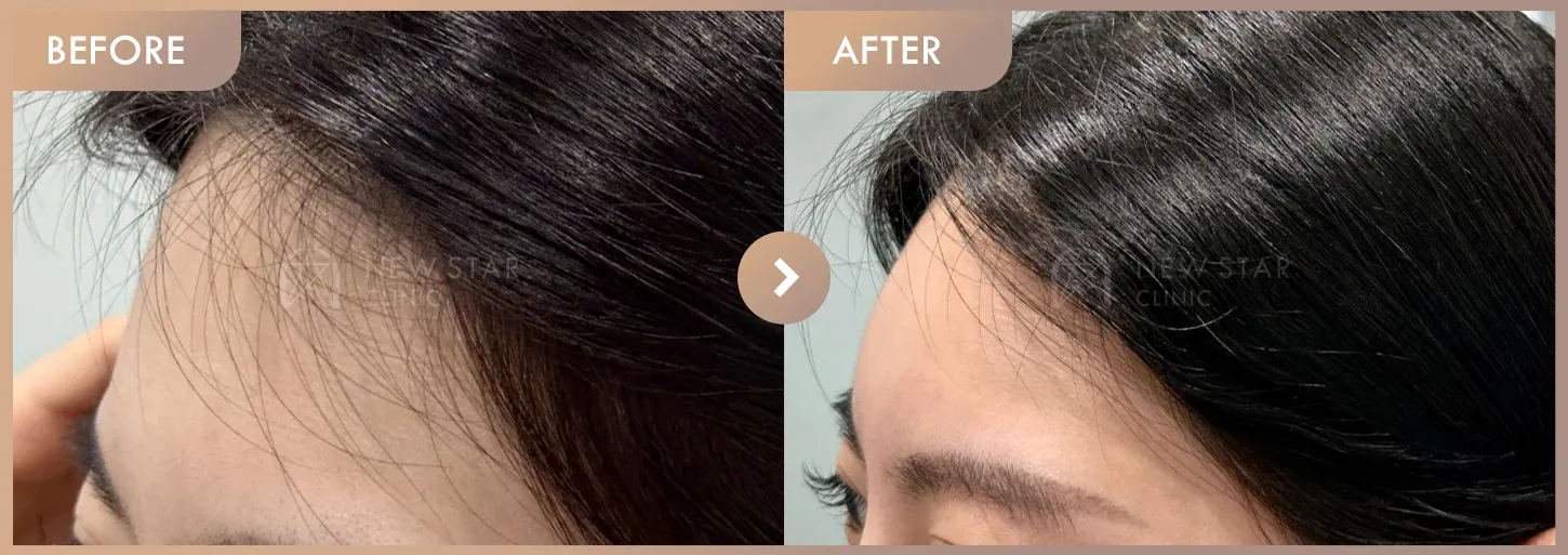 5b2c-48f3-84f3-a14e6e413a2a before-and-after photos at Newstar Clinic