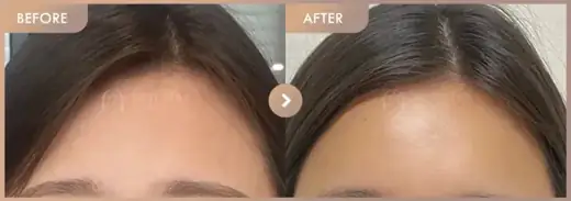 Forehead fillers: before-and-after comparison at Newstar Clinic