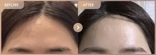 Forehead fillers: before-and-after comparison at Newstar Clinic