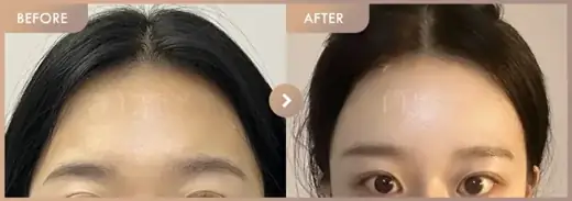Forehead fillers: before-and-after comparison at Newstar Clinic