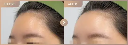 Forehead fillers: before-and-after comparison at Newstar Clinic