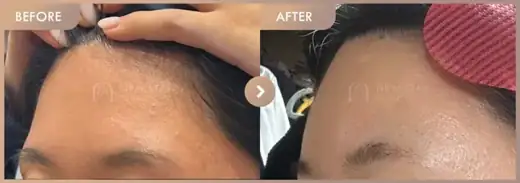 Forehead fillers: before-and-after comparison at Newstar Clinic