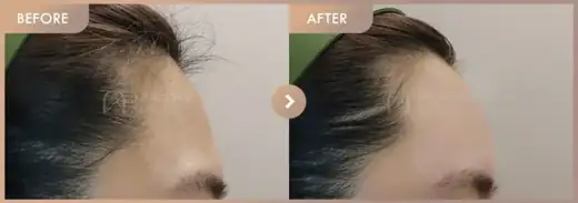 Forehead fillers: before-and-after comparison at Newstar Clinic