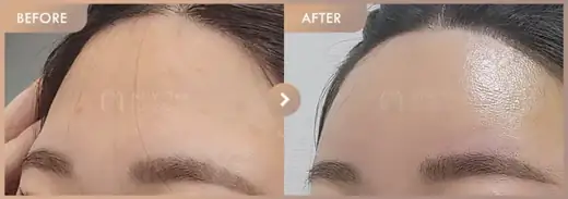 Forehead fillers: before-and-after comparison at Newstar Clinic