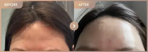 Forehead fillers: before-and-after comparison at Newstar Clinic