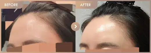 Forehead fillers: before-and-after comparison at Newstar Clinic