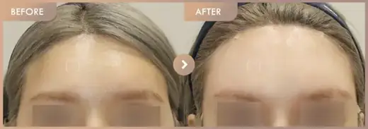 Forehead fillers: before-and-after comparison at Newstar Clinic