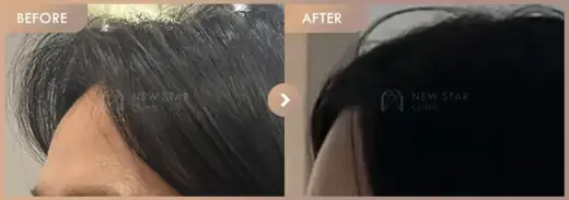 Forehead fillers: before-and-after comparison at Newstar Clinic