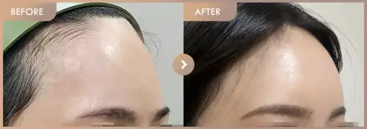 Forehead fillers: before-and-after comparison at Newstar Clinic