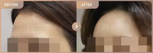 Forehead fillers: before-and-after comparison at Newstar Clinic
