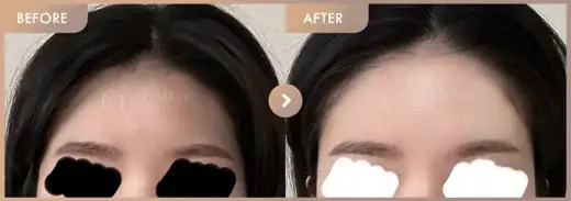 Forehead fillers: before-and-after comparison at Newstar Clinic