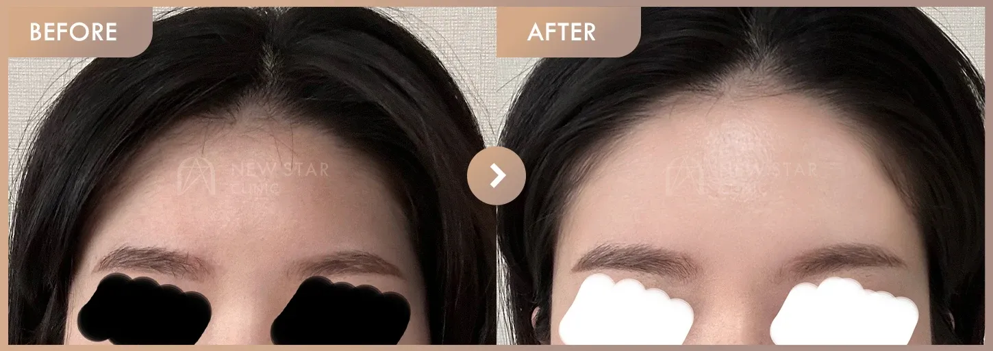 Forehead fillers before-and-after photos at Newstar Clinic