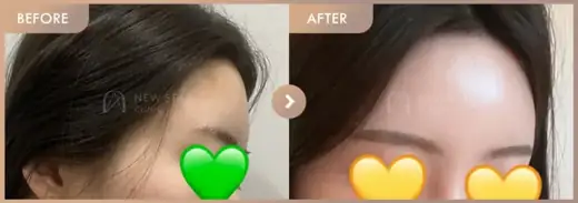 Forehead fillers: before-and-after comparison at Newstar Clinic
