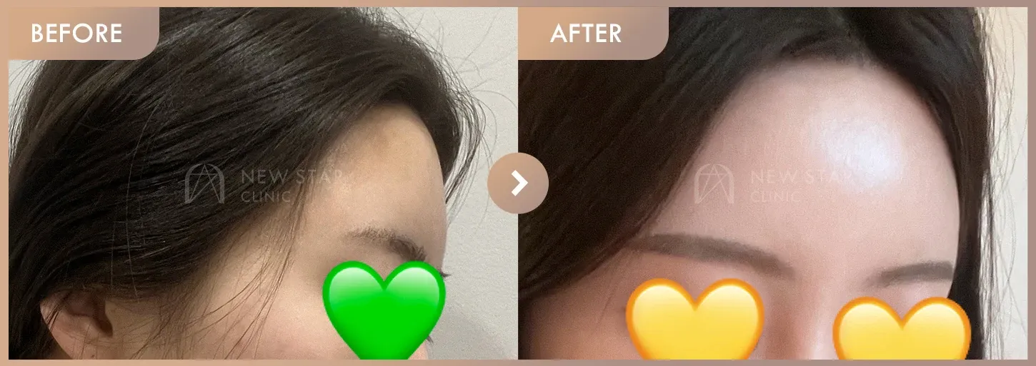 Forehead fillers before-and-after photos at Newstar Clinic