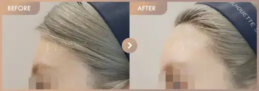 Forehead fillers: before-and-after comparison at Newstar Clinic