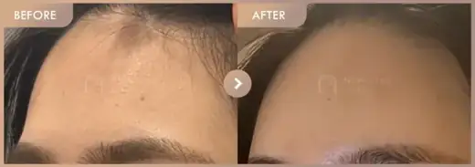 Forehead fillers: before-and-after comparison at Newstar Clinic