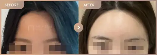 Forehead fillers: before-and-after comparison at Newstar Clinic