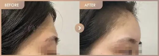 Forehead fillers: before-and-after comparison at Newstar Clinic