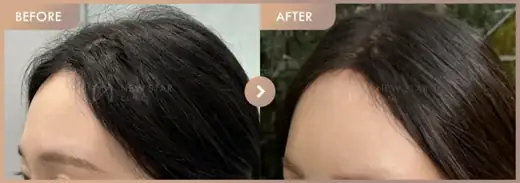 Forehead fillers: before-and-after comparison at Newstar Clinic