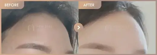Forehead fillers: before-and-after comparison at Newstar Clinic