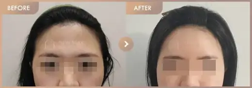 Forehead fillers: before-and-after comparison at Newstar Clinic