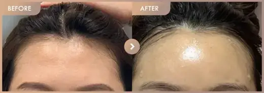 Forehead fillers: before-and-after comparison at Newstar Clinic