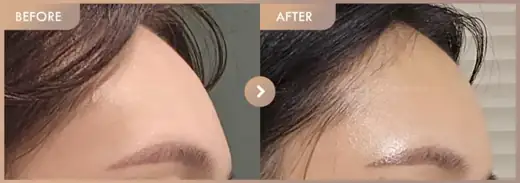 Forehead fillers: before-and-after comparison at Newstar Clinic