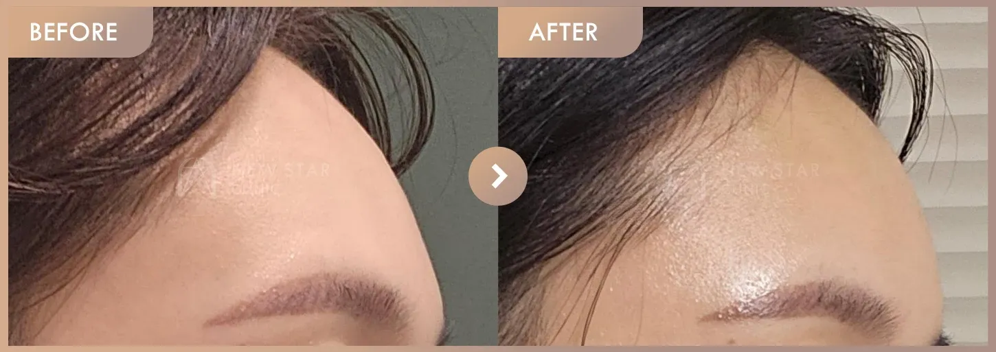 Forehead fillers before-and-after photos at Newstar Clinic