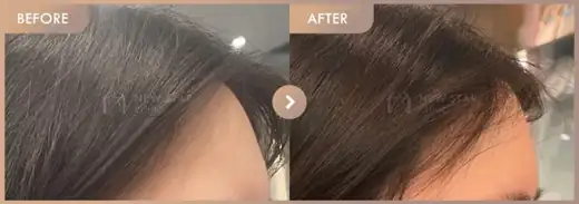 Forehead fillers: before-and-after comparison at Newstar Clinic