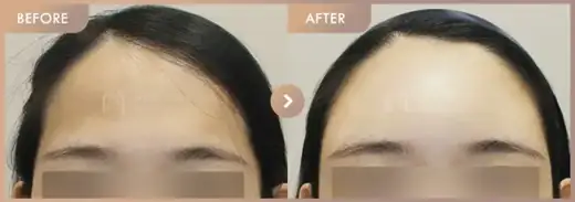Forehead fillers: before-and-after comparison at Newstar Clinic
