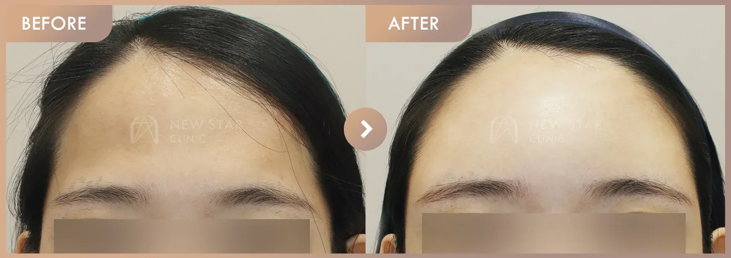 Forehead fillers before-and-after photos at Newstar Clinic