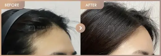 Forehead fillers: before-and-after comparison at Newstar Clinic